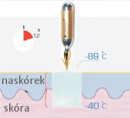 Krioterapia zamrażanie